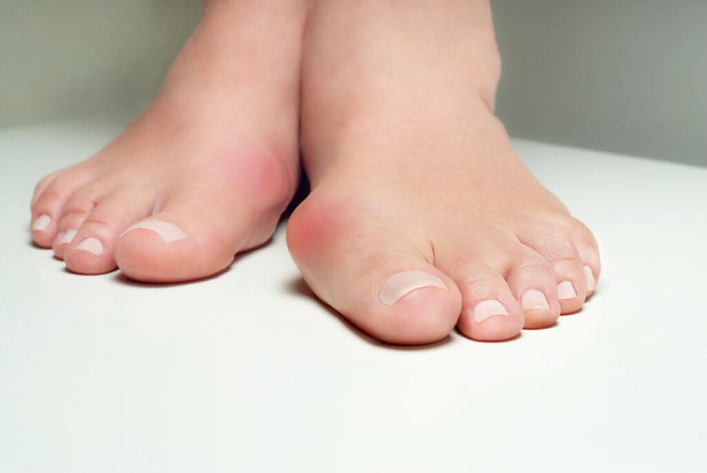 foot bunion